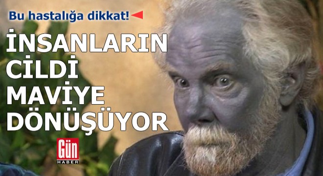 Bu hastalık insanları maviye çeviriyor!