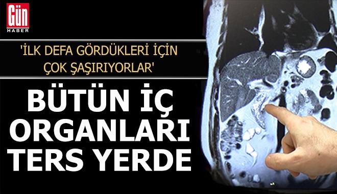 Bütün iç organları ters yerde